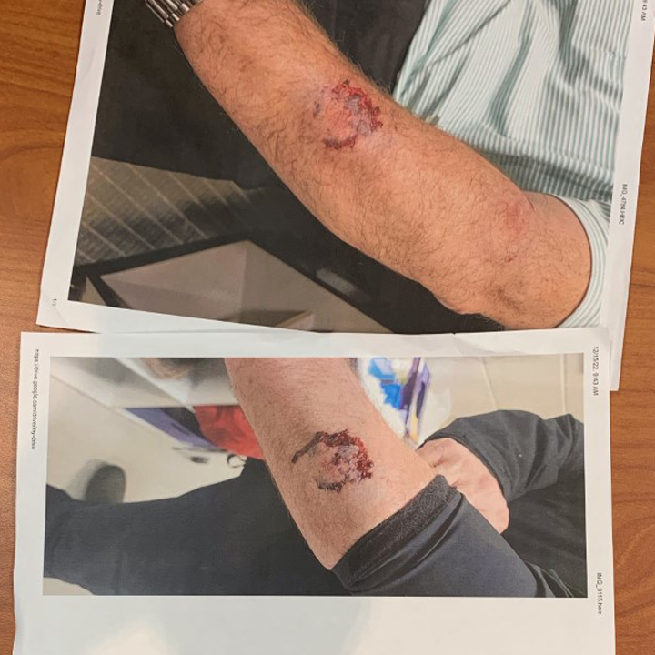 waff48's tweet photo. GRAPHIC WARNING: Madison City Schools Superintendent Dr. Ed Nichols provided these photos of bite marks sustained by a James Clemens Assistant Principal during an altercation on a bus with a student. The unblurred photo can be found in our story. https://t.co/i9Vhq5lSCd https://t.co/ZvXv8A9qPn