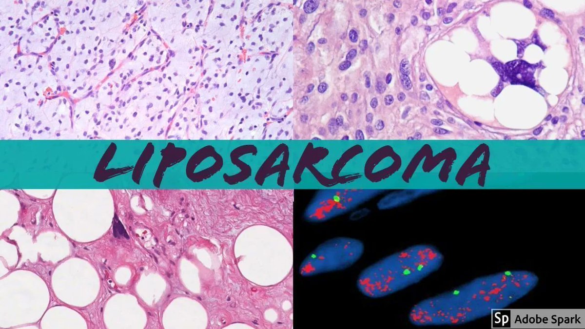 Jerad Gardner Md On Twitter How To Diagnose And Subtype Liposarcoma