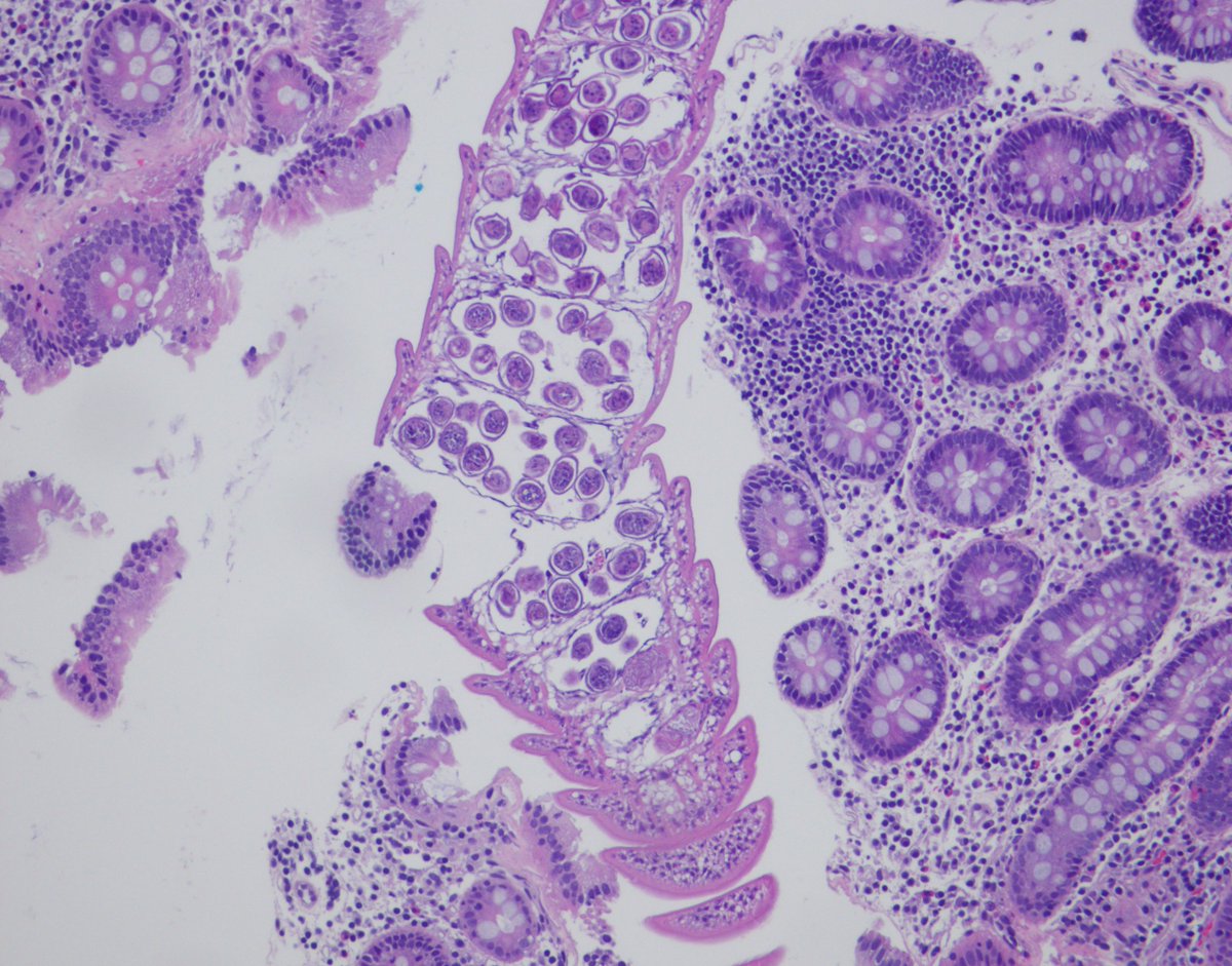 Vijuananthan's tweet image. Any thoughts on this beautiful, elegant creature that "crawled" into the colonic mucosa and presented as polyp !! I have been googling it for ages and can't find a morphologic fit with any of the adult/ larval parasitic  forms that I have ever encountered. Pt is asymptomatic.