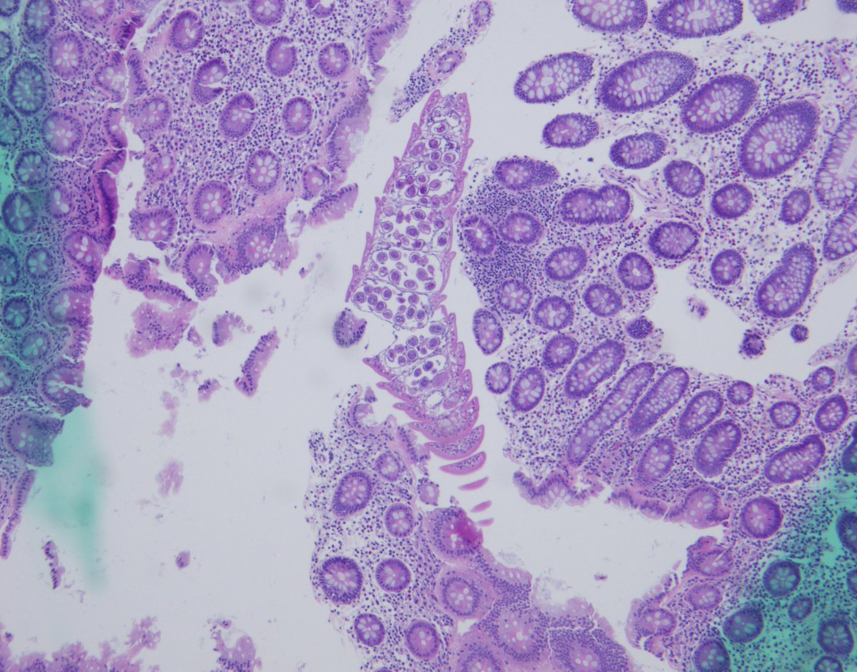 Vijuananthan's tweet image. Any thoughts on this beautiful, elegant creature that "crawled" into the colonic mucosa and presented as polyp !! I have been googling it for ages and can't find a morphologic fit with any of the adult/ larval parasitic  forms that I have ever encountered. Pt is asymptomatic.