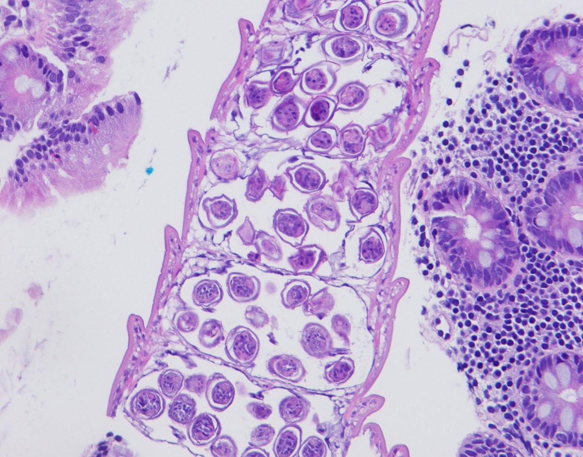 Vijuananthan's tweet image. Any thoughts on this beautiful, elegant creature that "crawled" into the colonic mucosa and presented as polyp !! I have been googling it for ages and can't find a morphologic fit with any of the adult/ larval parasitic  forms that I have ever encountered. Pt is asymptomatic.