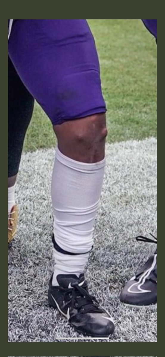 David J. Chao ProFootballDoc on Twitter "What are these weird bumps on JKDobbins knee? https