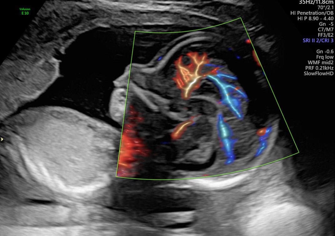 DLemaire78's tweet image. Pericallosal Artery:
#Slowflow