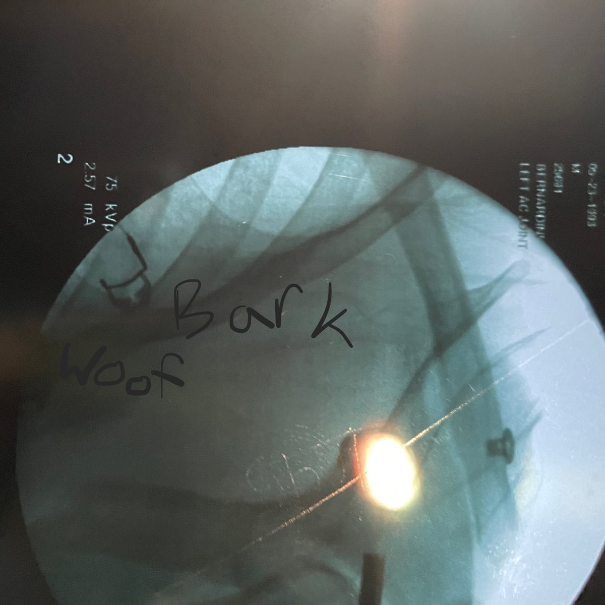 Shoulder Surgery results.