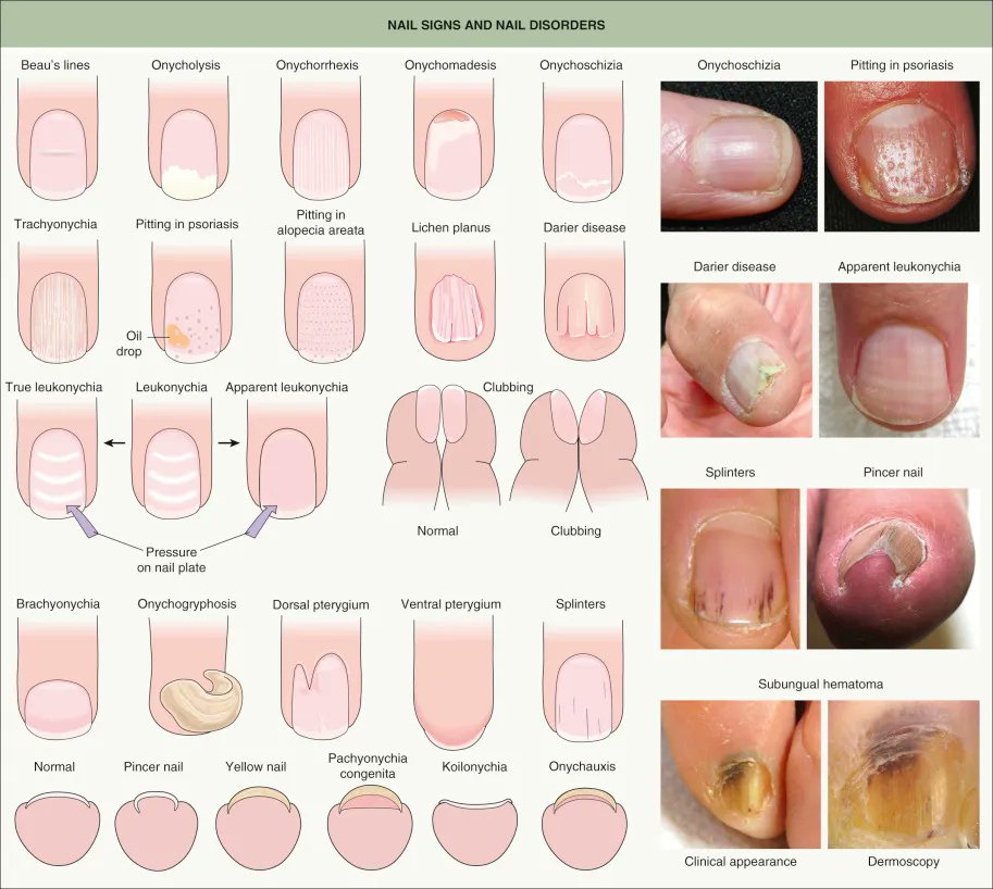 Innov_Medicine's tweet photo. Nail signs &amp; nail disorders 
#BJHM #MedEd #FOAMed #Medtwitter #IMpearls #physicalexam #Medpeds #medstudenttwitter #INNOMed https://t.co/q9imhapW77