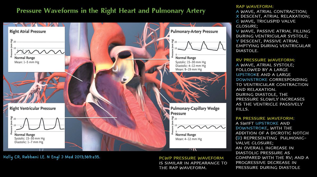 Normal Pcwp Rhc Pulmonary Artery Wedge Pressure