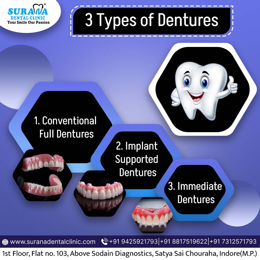 suranadental's tweet photo. 3 Types of Dentures
.
#dentures #dental #dentistry #dentist #teeth #smile #dentalimplants #dentaltechnician #teethwhitening #health #dentalcheckup #cleaningteeth #dentistry #suranadentalclinic #dentalclinic #indore #indorepost #bestclinic https://t.co/2A2nydSxVT