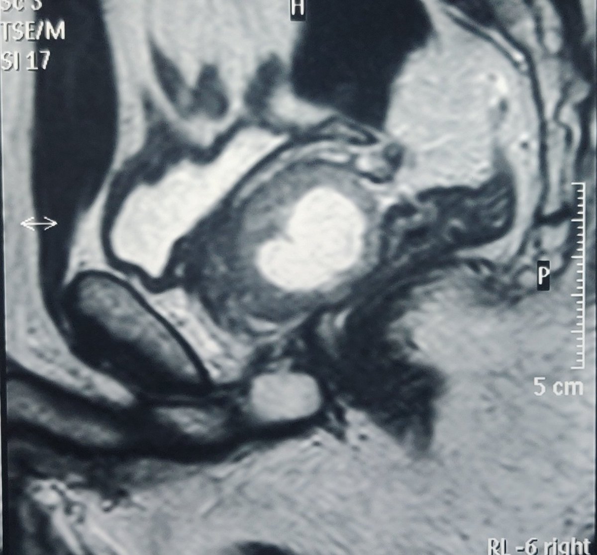 Synovial sarcoma of prostate
Rare disease, complete surgical resection offers best results. Did robotic radical prostatectomy