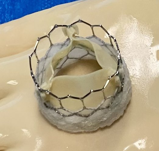 quentinlandolff's tweet photo. First TAVI Sapien 3 Ultra (@EdwardsLifesci @Edwards_TAVR ) today in hybrid room in Rouen with good final angiographic result
@mattgodin1 https://t.co/TwI5F4AhZ6