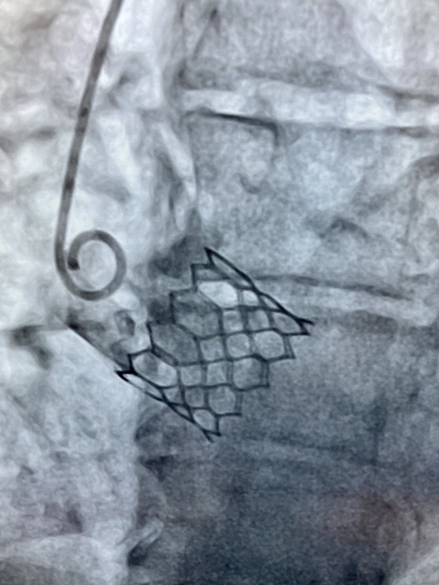 First TAVI Sapien 3 Ultra (@EdwardsLifesci @Edwards_TAVR ) today in hybrid room in Rouen with good final angiographic result @mattgodin1