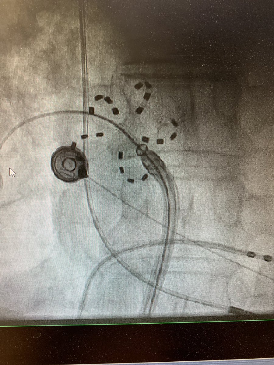 PLugenbiel's tweet photo. PFA arrived at Heidelberg Center for Rhythm Disorders. Impressive fast and safe technology to perform durable PV isolation. Thanks to Boston Scientific for the great support. @ArminLuik @KathrinRahm @AGEP_DGK @MauraZylla @DavidDuncker @BeinartRoy https://t.co/XOF7k9fftC