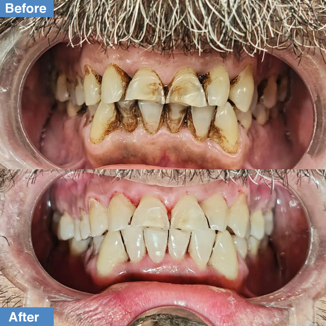 SmileCenterISB's tweet photo. Patient came to our clinic because he was conscious of his smile. On examination, severe tobacco stains were found. 
Scaling and polishing was advised along with the use of prophy. 
The after results are dramatically amazing.
Patient has been called for a second visit also https://t.co/l4P5YP8J5C