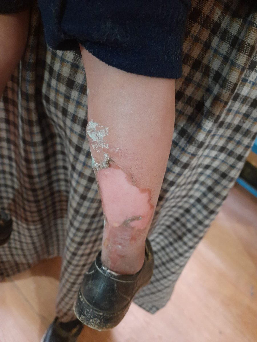 181SrinagarCRPF's tweet photo. At unit Hosp 181 BN, a child namely Md Tanzim Dar, age 4 years, S/o Md Altaf Dar,R/o vill Zinpanjal has been treated for burn injuries. Child got instant relief and parents breathed a sigh of relief. For philanthropic gesture parents thanked Comdt and medical team of 181 BN CRPF. https://t.co/keQLZPItkS