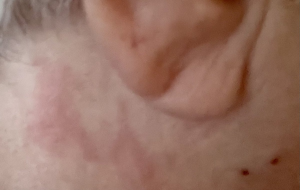 Dragonflynda's tweet photo. Weird marks this morning with two holes below ear. https://t.co/NLrVaUwwpO