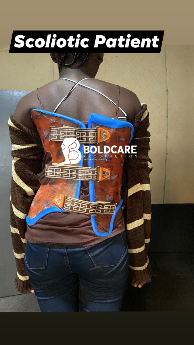 Boldcarepro's tweet photo. BOSTON BRACE: This is typically used in Correcting and Preventing the Curvature of the Spine in Patients with SCOLIOSIS.
#orthoticfittings
#scoliosis
#orthotics
#spinalorthosis
#thoracolumbarcurve
#myprofession
#mypride
Contact us For PROSTHETIC/ORTHOTIC SERVICES. https://t.co/BSEaQGNv64