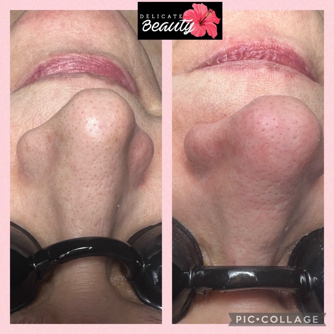 DelicateBeaut_'s tweet photo. Coming for monthly facials and using the correct products at home will not only reduce sebaceous filaments but decrease the stretching of the pores that it causes. 

Toning, exfoliating and using AHA/BHAs will help

#chemicalpeels  #facialskincare #facialspa #extractions #glow https://t.co/rBFv7PUmOf