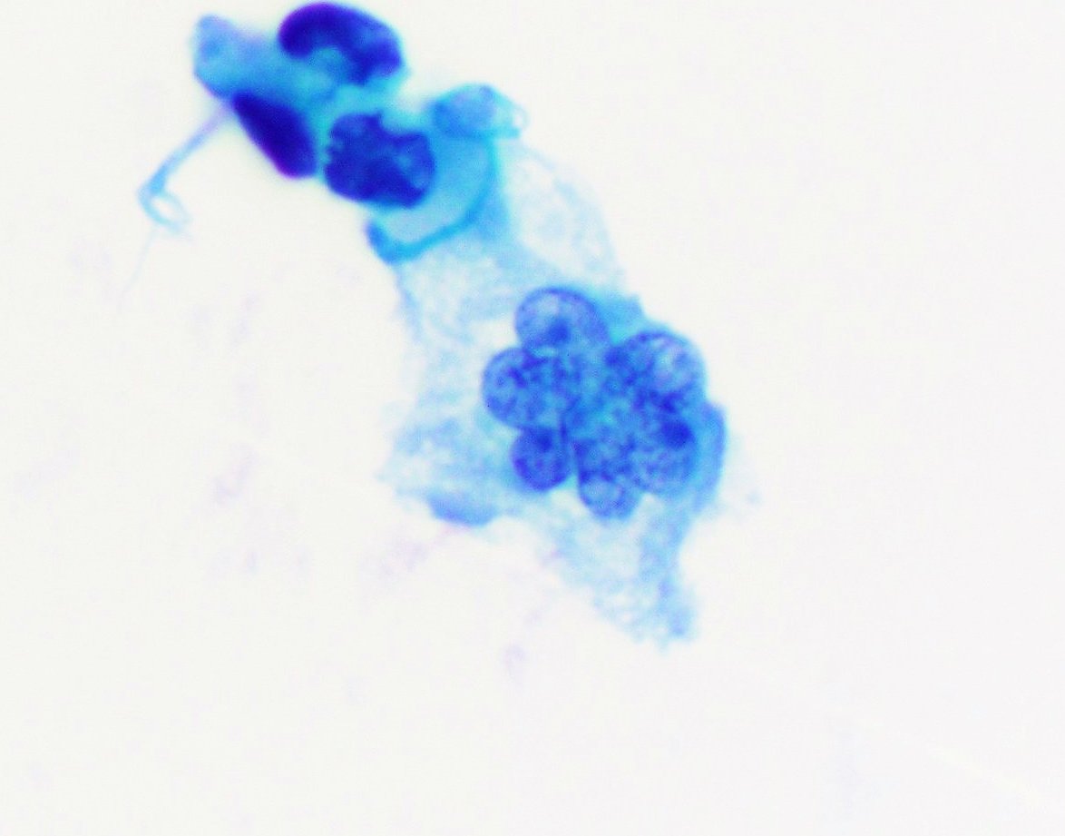 VandaTorousMD's tweet photo. A pretty & benign lobulated "daisy" mesothelial cell in a pelvic wash for this #FluidsFriday 🌸😃
#TGIF #CytoPath #PathTwitter https://t.co/86er36f0EN