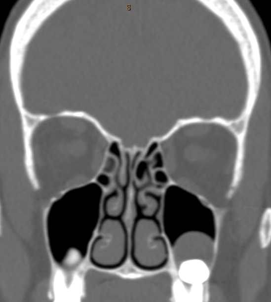 DrScottFortune's tweet photo. 50 yo F with symptom of cigarette smoke smell when no odorants present. Scans revealed this finding. Diagnosis? Treatment plan? #Rhinology #SinusCTscans #MRIorbits #radiology #imaging #RhinologyClinic https://t.co/xRhstyYnQq