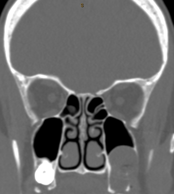 DrScottFortune's tweet photo. 50 yo F with symptom of cigarette smoke smell when no odorants present. Scans revealed this finding. Diagnosis? Treatment plan? #Rhinology #SinusCTscans #MRIorbits #radiology #imaging #RhinologyClinic https://t.co/xRhstyYnQq
