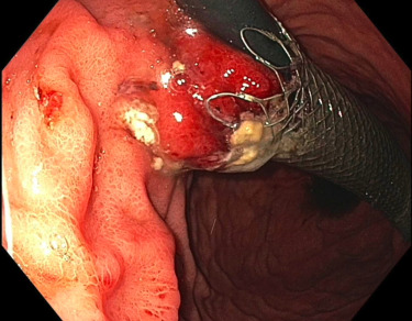 videogie's tweet photo. Aman Deep et al explore "Cryotherapy for removal of an embedded, partially covered esophageal stent," a recent case report published by VideoGIE. https://t.co/dsqc0vgMhi

@Aman_Deep_MD https://t.co/bwASnNkcRk