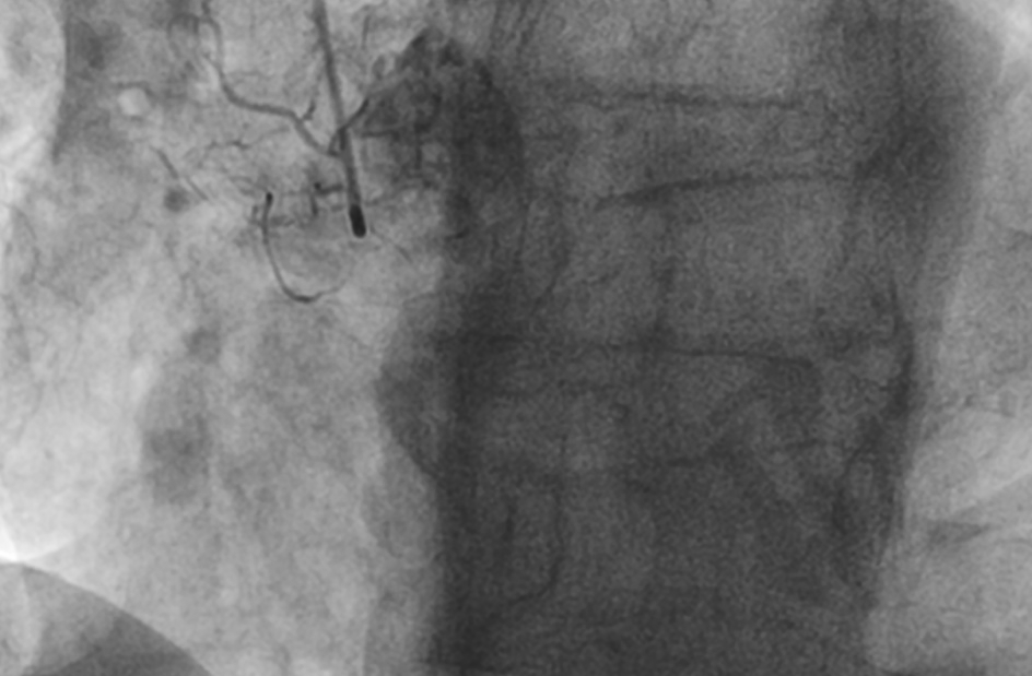 Ferrarajerome1's tweet photo. Still learning in la Timone Hospital, Marseille with @deharo_pierre @AntoineVaillier @CuissetDr. Ostial RCA CTO. Always antegrade first. Puncture with HORNET 14. True Lumen with GAIA 3rd. Rotational atherectomy @Avranctotrip @RinfretStephane @KambisMashayek1 @MLCTOAcademy https://t.co/KLRPtBy1ff