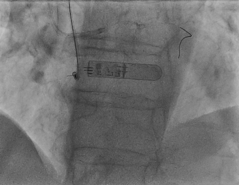 Ferrarajerome1's tweet photo. Still learning in la Timone Hospital, Marseille with @deharo_pierre @AntoineVaillier @CuissetDr. Ostial RCA CTO. Always antegrade first. Puncture with HORNET 14. True Lumen with GAIA 3rd. Rotational atherectomy @Avranctotrip @RinfretStephane @KambisMashayek1 @MLCTOAcademy https://t.co/KLRPtBy1ff