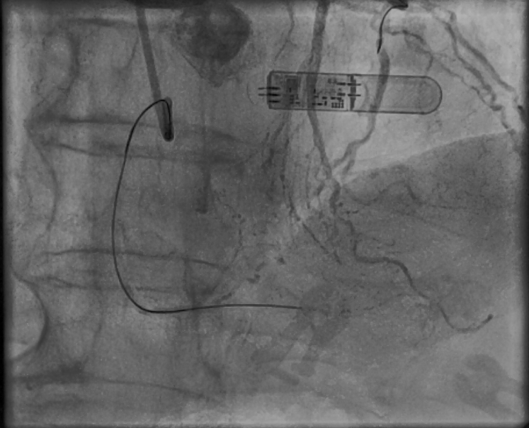 Ferrarajerome1's tweet photo. Still learning in la Timone Hospital, Marseille with @deharo_pierre @AntoineVaillier @CuissetDr. Ostial RCA CTO. Always antegrade first. Puncture with HORNET 14. True Lumen with GAIA 3rd. Rotational atherectomy @Avranctotrip @RinfretStephane @KambisMashayek1 @MLCTOAcademy https://t.co/KLRPtBy1ff