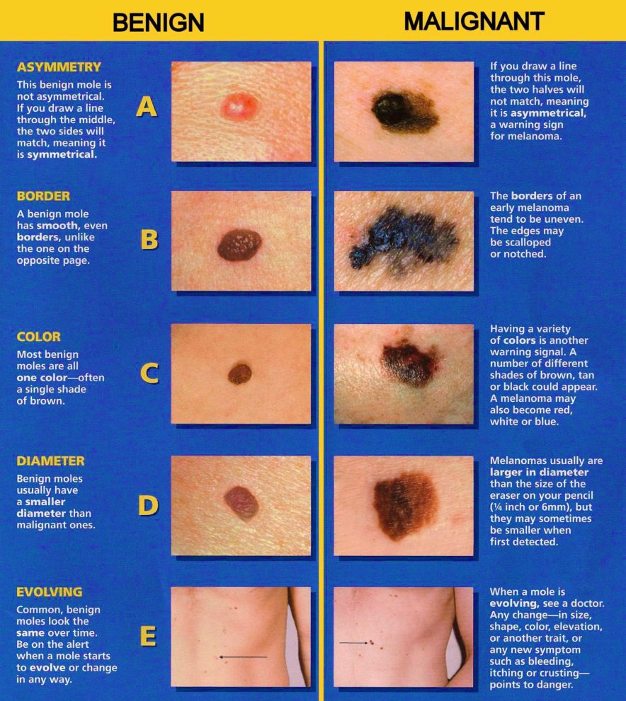 Studying Medicine on Twitter "Benign and malignant tumors reported at