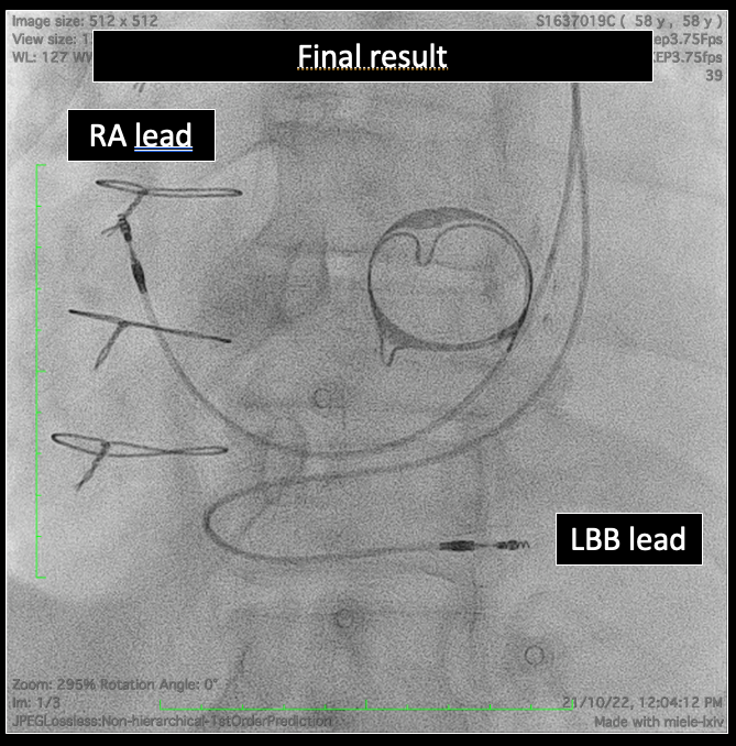ericlim1975's tweet photo. 1/ I haven't seen many #Epeeps share #LBBPacing / #PhysiologicPacing cases using the sheath-in-sheath technique or  Agilis #HisPro, so I thought I would share some such cases -including a fun LBB pacing case with PLSVC. How often do #Epeeps use such techniques? https://t.co/qQOCP53AiH