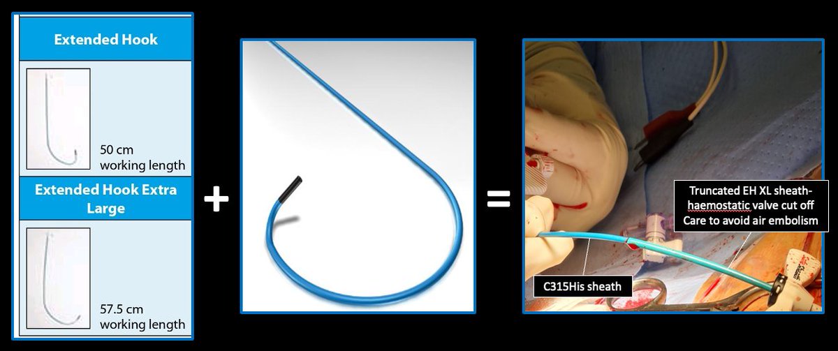 ericlim1975's tweet photo. 1/ I haven't seen many #Epeeps share #LBBPacing / #PhysiologicPacing cases using the sheath-in-sheath technique or  Agilis #HisPro, so I thought I would share some such cases -including a fun LBB pacing case with PLSVC. How often do #Epeeps use such techniques? https://t.co/qQOCP53AiH