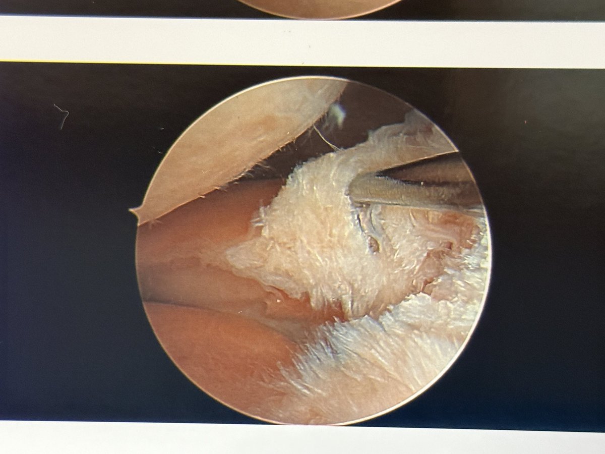 jonathanrothMD's tweet photo. It's tweeted, then one shows up.

Lateral posterior root tear -> repair

#savethemeniscus #orthotwitter https://t.co/FuBT0ev2nB