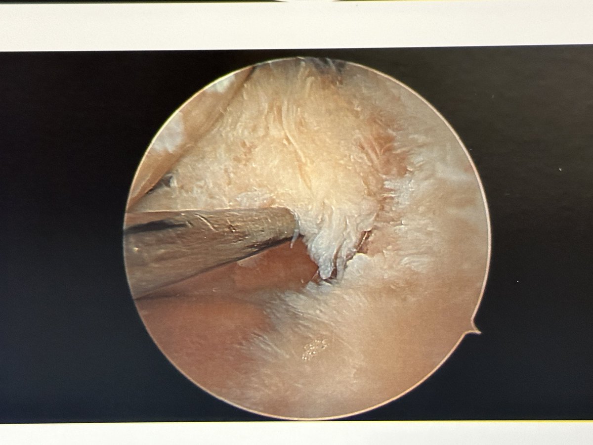 jonathanrothMD's tweet photo. It's tweeted, then one shows up.

Lateral posterior root tear -> repair

#savethemeniscus #orthotwitter https://t.co/FuBT0ev2nB