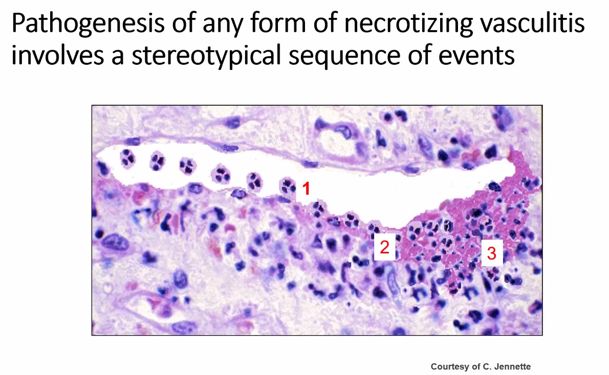hopkinsneph's tweet photo. An absolute tour de force from our very own @DuvuruG providing a detailed overview of #ANCA associated vasculitis, from pathophysiology, through the history of clinical trials and the future of therapeutics! https://t.co/v0uN6bE5yv