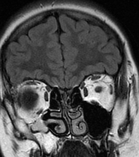 DrScottFortune's tweet photo. 13 yo F w daily headaches but no aura, with phonophobia/photophobia, nausea is referred w these imaging findings Diagnosis? Treatment plan? Describe the abnormality Will endoscopic sinus surgery "cure" the headaches? Any risks? #Rhinology #RhinologyClinic #SinusCTscan #MRIorbits https://t.co/32pkGqMNDs