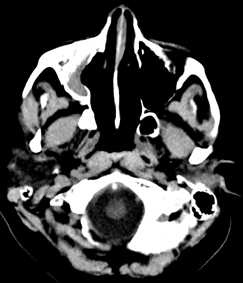 DrScottFortune's tweet photo. 13 yo F w daily headaches but no aura, with phonophobia/photophobia, nausea is referred w these imaging findings Diagnosis? Treatment plan? Describe the abnormality Will endoscopic sinus surgery "cure" the headaches? Any risks? #Rhinology #RhinologyClinic #SinusCTscan #MRIorbits https://t.co/32pkGqMNDs