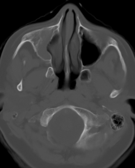 DrScottFortune's tweet photo. 13 yo F w daily headaches but no aura, with phonophobia/photophobia, nausea is referred w these imaging findings Diagnosis? Treatment plan? Describe the abnormality Will endoscopic sinus surgery "cure" the headaches? Any risks? #Rhinology #RhinologyClinic #SinusCTscan #MRIorbits https://t.co/32pkGqMNDs