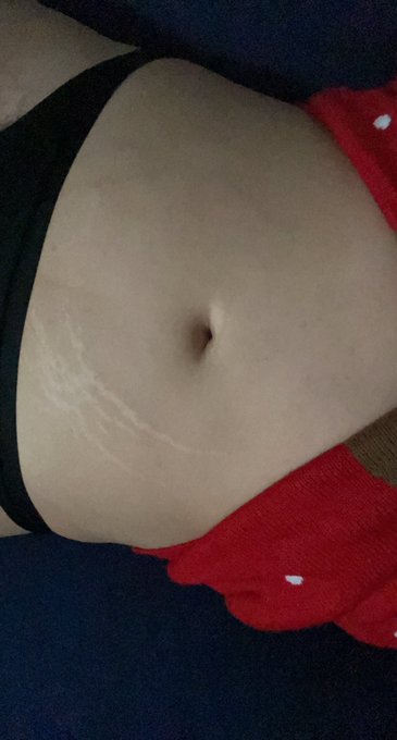 That was beyond rude and ignorant of you to say. I also have no children and have stretch marks all over