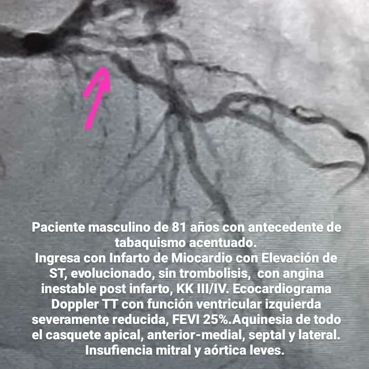 HemodinamiaNews's tweet photo. Px Masc 81a con tabaquismo acentuado.#iamcest, evolucionado, sin trombolisis, con angina inestable post infarto, KK III/IV. FEVI 20%.Aquinesia anterior-medial y apical;infero-apical.Lesión proximal de la Arteria Descendente Anterior 99% y CD 70%. #radialfirst https://t.co/YHcvYcvrv9