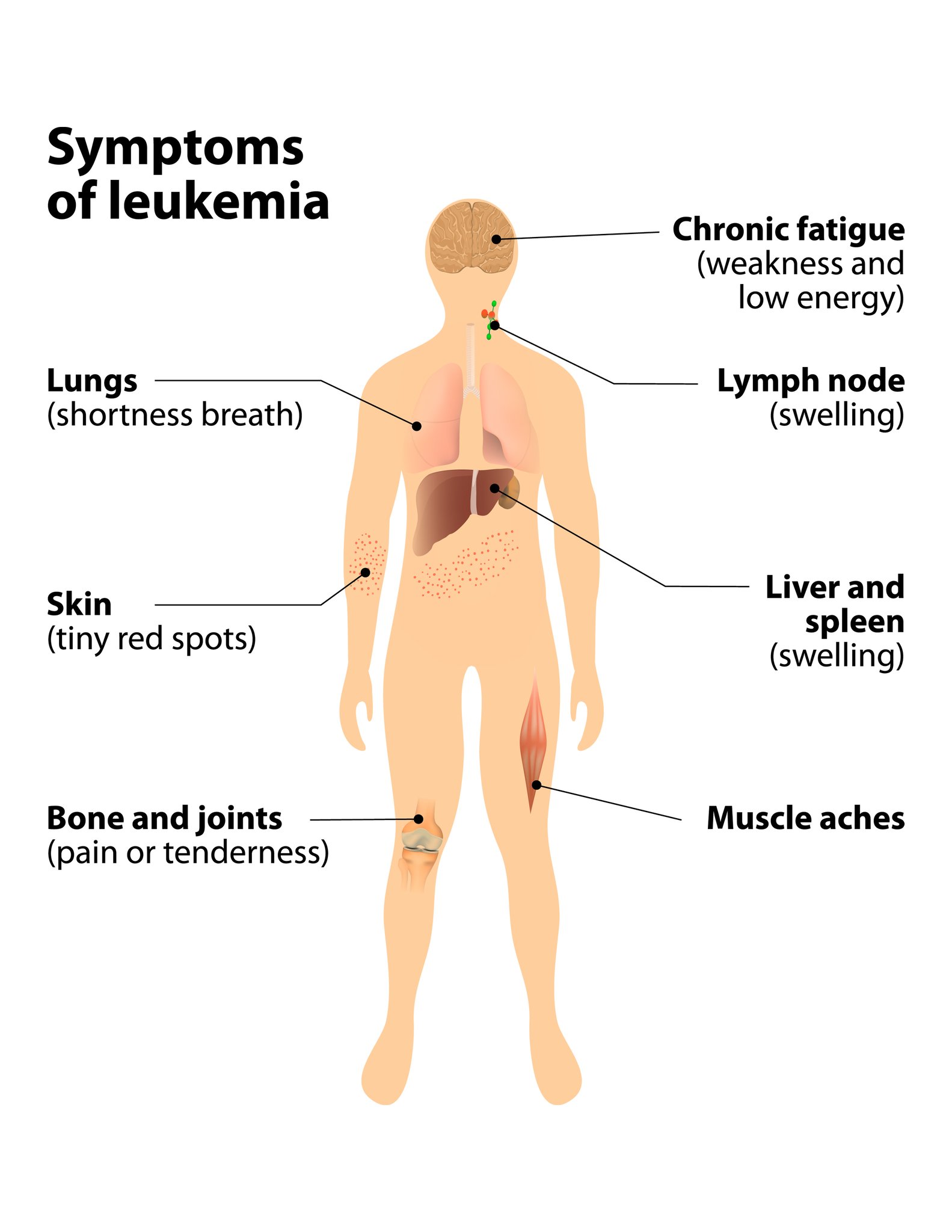 First Doktor On Twitter 8 Common Symptoms Of Blood Cancer Or Leukemia First Doktor On Twitter 8 Common Symptoms Of Blood Cancer Or Leukemia