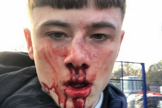 daveatherton's tweet photo. In Stafford, Harvey Pickering, 16, was attacked by 10 Asian men in masks outside Buzz Bingo in Stafford, walking home from school.

In what appears a motiveless attack, happened in broad daylight when he was ambushed at around 3pm on Tuesday.
https://t.co/luocyUT6qd https://t.co/MaTxlW7hjU