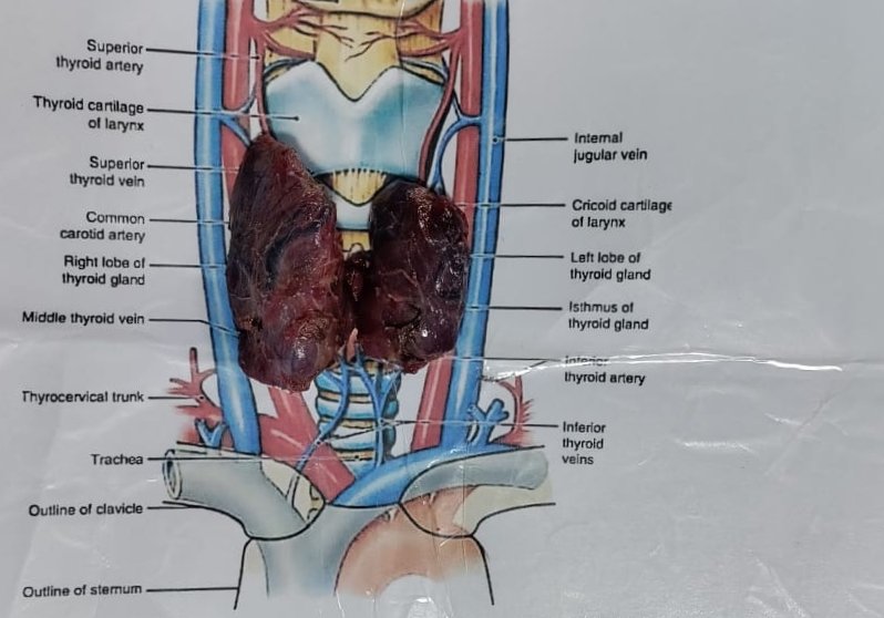 drskyind's tweet photo. She was stabilized and then operated. 
Indian #MedTwitter don't keep patients on ATD indifinetly 
#GravesDisease #GDAM2022 @GDATF @IndianSurgeons @TheAAES @AmThyroidAssn https://t.co/YUMERjSIkt