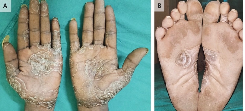 BrownJHM's tweet photo. A 30-year-old man presented with a rash on his face, hands, and feet. He had a history of HIV with a CD4+ T-cell count of 374 per cubic millimeter. What is the likely diagnosis? @ManualOMedicine #MedEd https://t.co/N81LNi9vu4