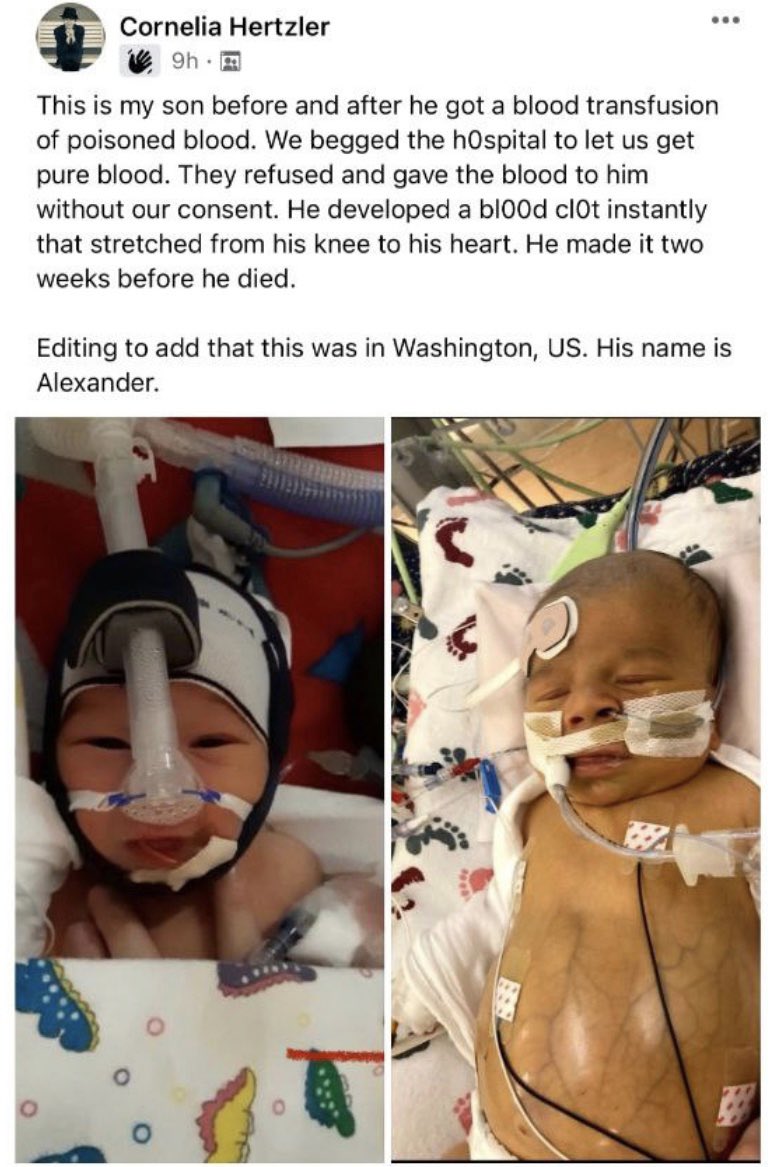 DiedSuddenly_'s tweet image. Crimes Against Humanity: 

1 month old baby dies horrific death after receiving a transfusion with vaccinated 💉blood. 

Within hours of receiving the transfusion, a blood clot formed from his knee to his heart. His veins turned black and his skin turned yellow. 

#diedsuddenly