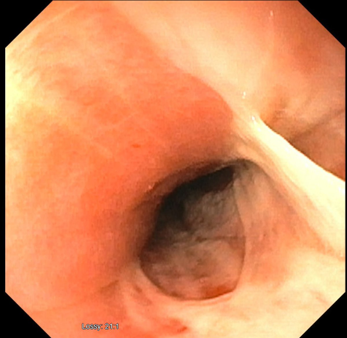 Any guesses on this EGD finding in a symptomatic 21 year old patient. Severe retrosternal chest discomfort and esophageal dysphagia to solids. Any guesses on underlying etiology? #GITwitter #MedTwitter #MedEd 
<a href="/AmCollegeGastro/">ACG</a> <a href="/ASGEendoscopy/">ASGE GI Endoscopy</a>