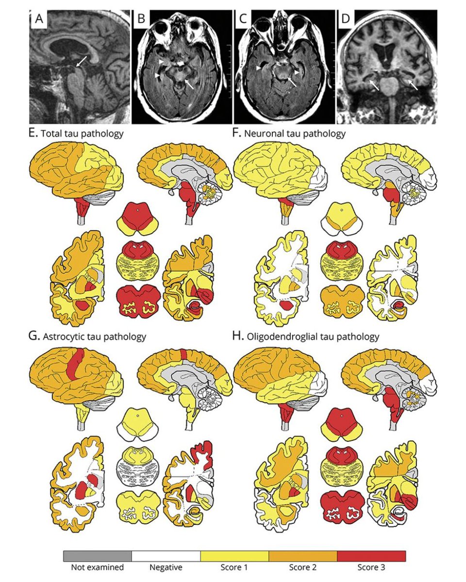 Progressive Supranuclear Palsy Syndrome Associated With a Novel Tauopathy: Case Study bit.ly/3ByKDav

#NeuroTwitter #Neurology
