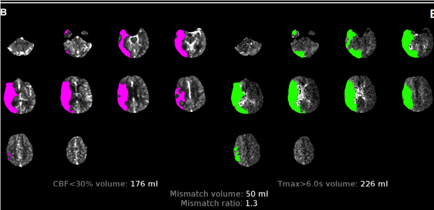 MicieliA_MD's tweet photo. CODE STROKE🧠⚡️

Patient is a CT tech at your hospital with witnessed, sudden onset L sided weakness, dysarthria. Stroke neurologist called immediately and assesses patient. NIHSS 15. 

Last seen well 10 min ago.

CT &amp; CTP below. Do you treat the patient?

#stroke #neurotwitter https://t.co/h7JlZpVf7t