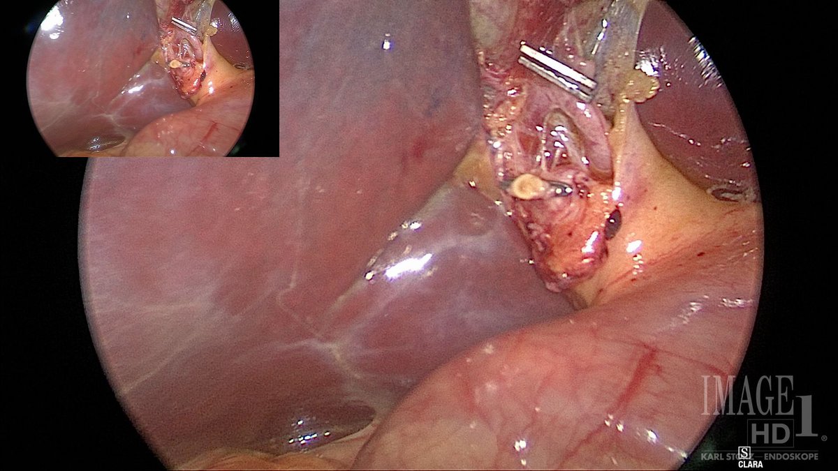 The critical view of safety. A “near miss” if the full view wasn’t obtained. 

Despite having a good view, I saw something odd and had the resident keep dissecting. It was the right hepatic and an extremely short cystic artery.