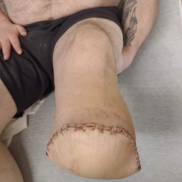 At4mark's tweet photo. @marcuslemonis I could use a mattress topper and some warm clothes. Finally going home tomorrow after my amputation been in hospital over a month #HolidaysWithMarcus https://t.co/V3pQnczDLt