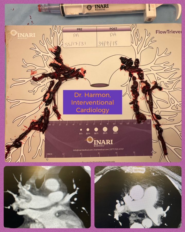 Submassive PE with acute onset shortness of breath. RV strain of 1.5 and trop elevation. Recent covid and surgery. Instant pressure drop and home in 48hrs after DVT was also treated. Doubt heparin to OAC would have same benefit. Mechanical thrombectomy 💪 #CardioTwitter