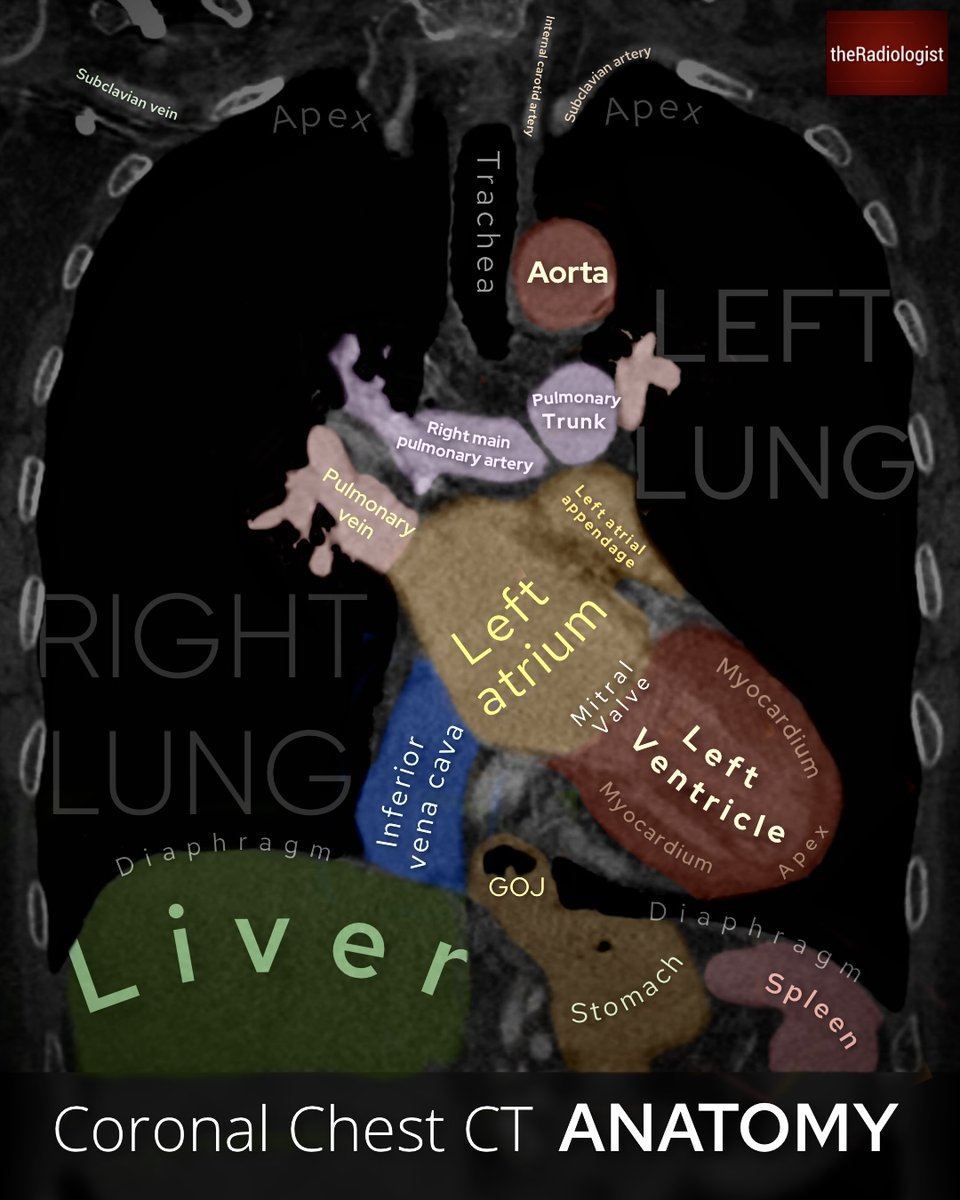 theRadiologist on Twitter "Coronal chest CT anatomy"